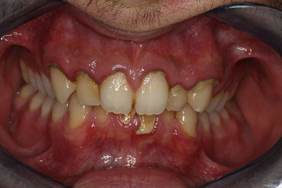 Gingivitis