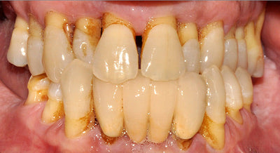 Periodontitis