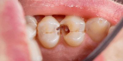 Caries dental Parte I